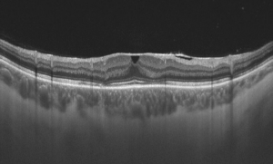 Vertical transfoveal OCT of an eye with epiretinal fibrosis Image courtesy of Rigshospitalet (Copenhagen)